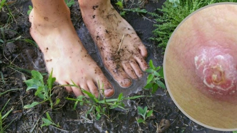 Tìm hiểu thông tin mới về bệnh whitmore dễ hiểu