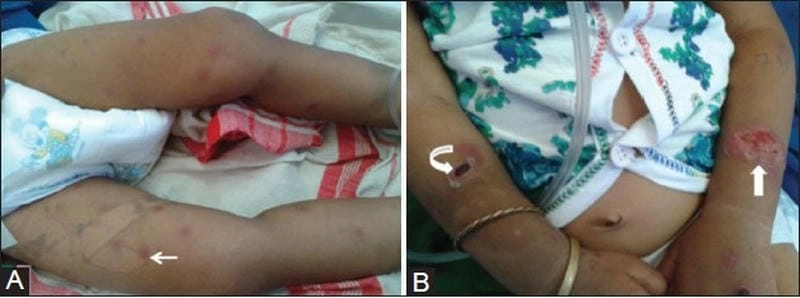 Bộ sưu tập hình ảnh bệnh whitmore rõ ràng chi tiết