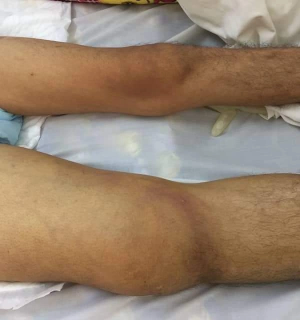 Bộ sưu tập minh họa ảnh bệnh whitmore chi tiết