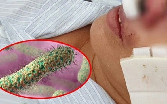 Hiểu rõ nguy cơ lây nhiễm từ virus whitmore