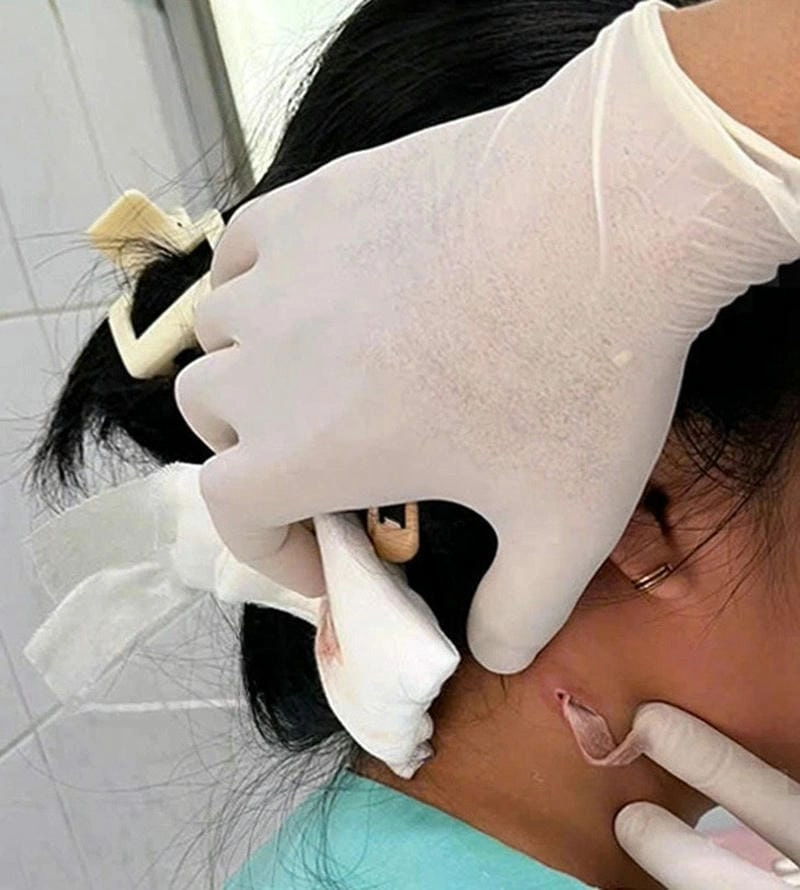 Trọn bộ hình ảnh bệnh whitmore đáng lưu ý cho bạn