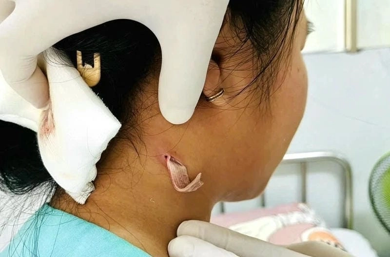 Cảnh báo nguy cơ từ bệnh whitmore vi khuẩn ăn thịt người