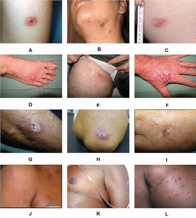 Thông tin chính xác về virus whitmore được cập nhật