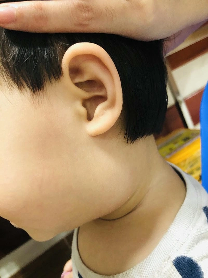 Giải đáp cách điều trị bệnh whitmore an toàn hiệu quả