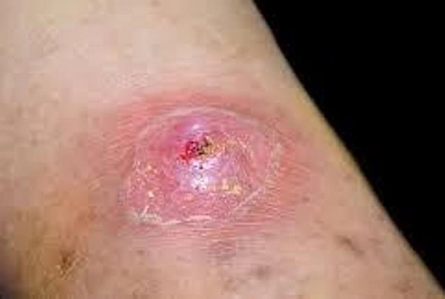 Xem nhanh ảnh bệnh whitmore giúp nhận diện sớm