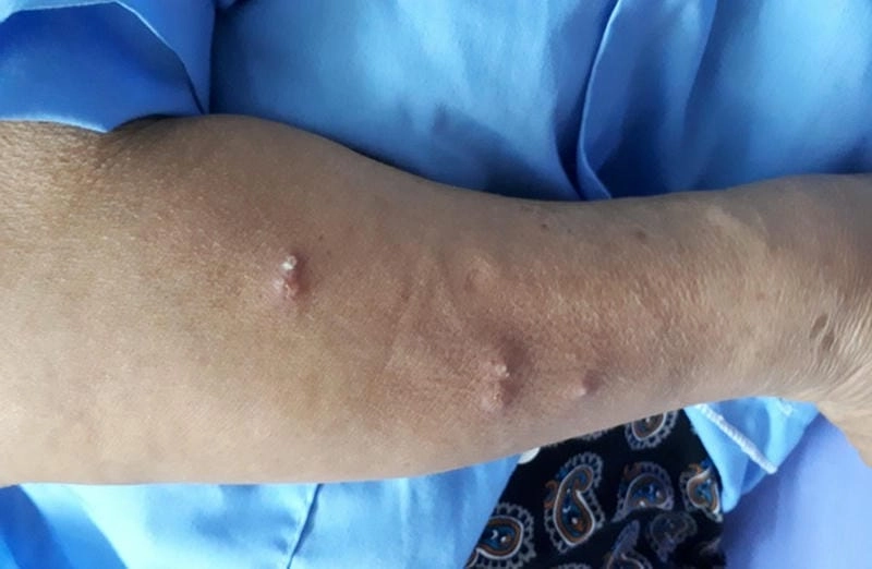 Bộ sưu tập ảnh bệnh whitmore minh họa sinh động