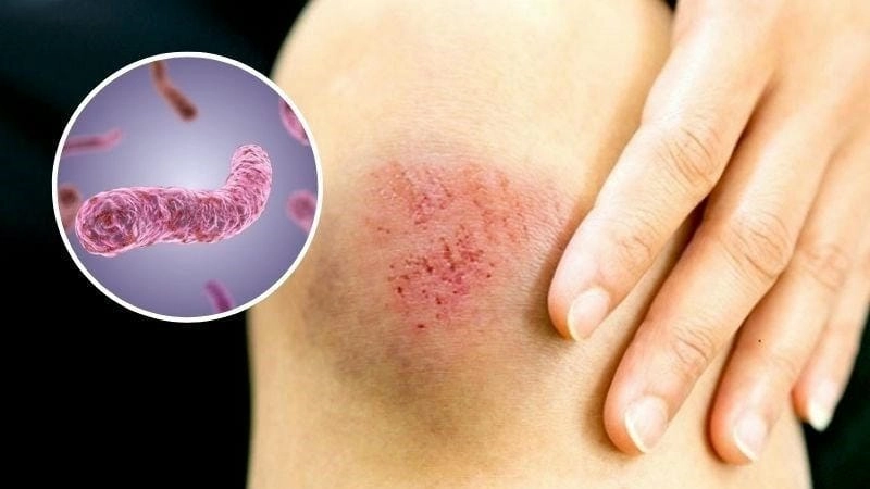 Khám phá hình ảnh người bệnh whitmore chân thực rõ ràng