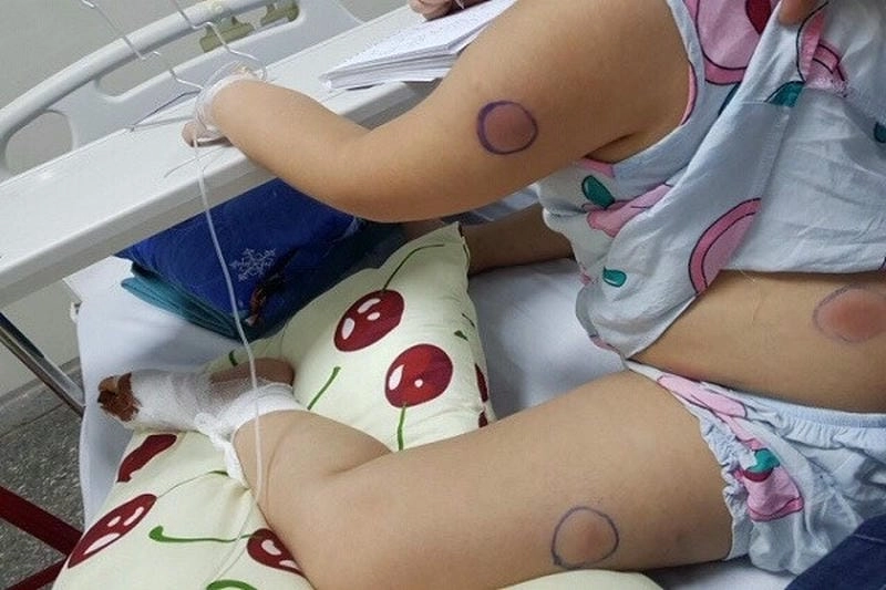 Thông tin về dịch whitmore đang được quan tâm nhiều