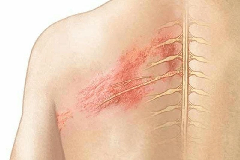 Dấu hiệu đau rát qua hình ảnh người bị zona thần kinh