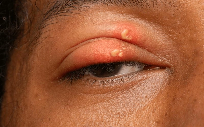 Quan sát vị trí lây lan từ ảnh zona ở người