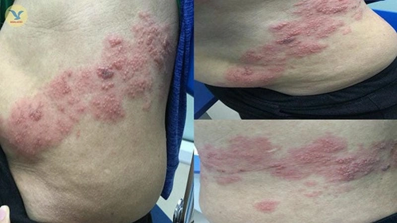 Giải đáp thắc mắc zona có bị lây không