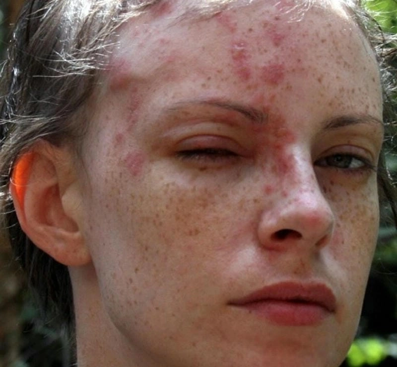 Cách phòng ngừa tái phát bệnh zona