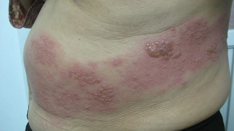 Chế độ dinh dưỡng phù hợp khi bị bệnh zona