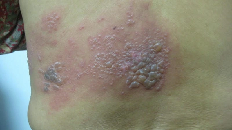 Cảnh báo biến chứng đau dây thần kinh từ ảnh zona ở người