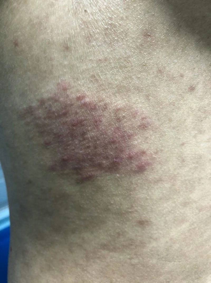 Mức độ nguy hiểm cho người bị bệnh zona