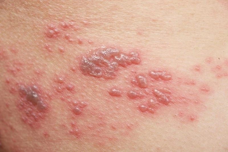 Cách chăm sóc đúng khi bị bệnh zona