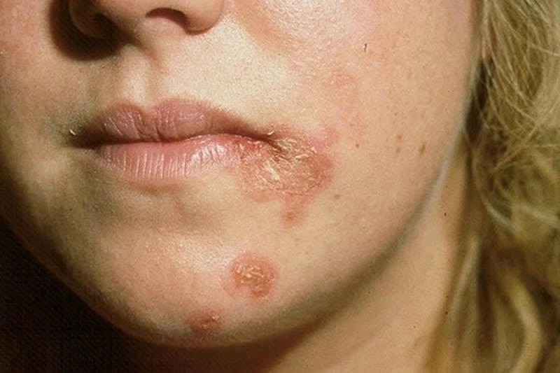 Chữa zona ở môi bằng thuốc bôi và nghỉ ngơi