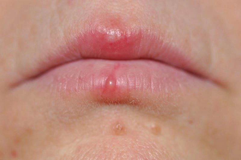 Thuốc bôi zona ở môi nên dùng theo chỉ định bác sĩ
