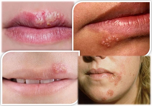 Thuốc trị zona ở môi thường gồm kháng virus