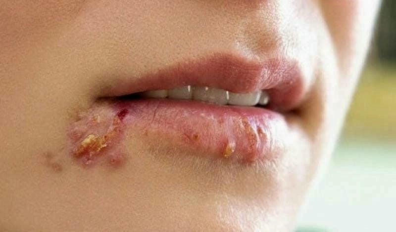 Triệu chứng zona ở miệng là loét đỏ rát quanh mép