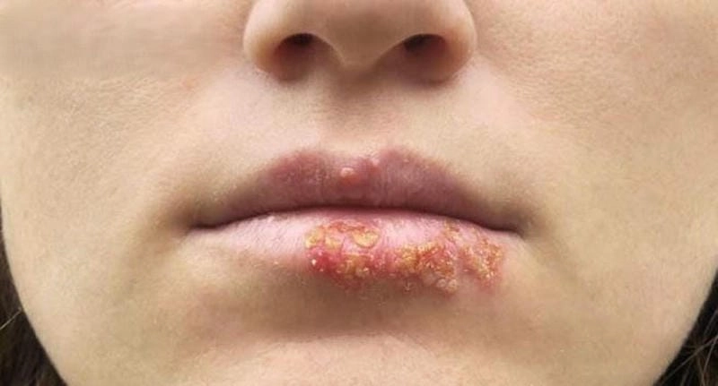 Triệu chứng zona ở môi gồm ngứa rát và sưng tấy