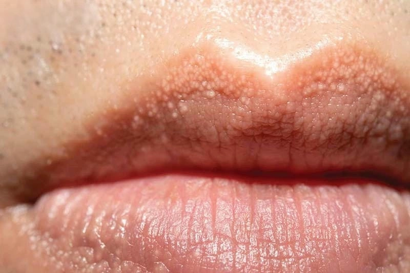 Zona có bị ở môi không là câu hỏi nhiều người quan tâm