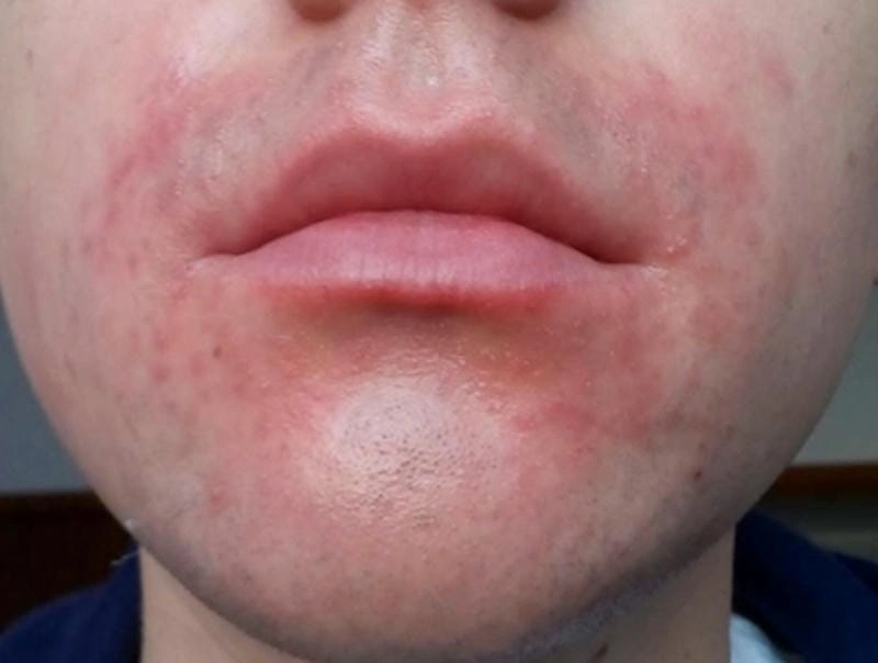 Zona mọc ở môi gây khó ăn uống sinh hoạt