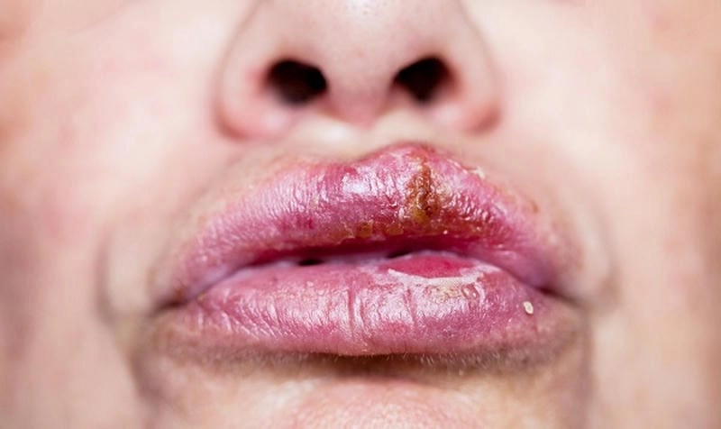 Bị zona ở môi thường đau rát kéo dài