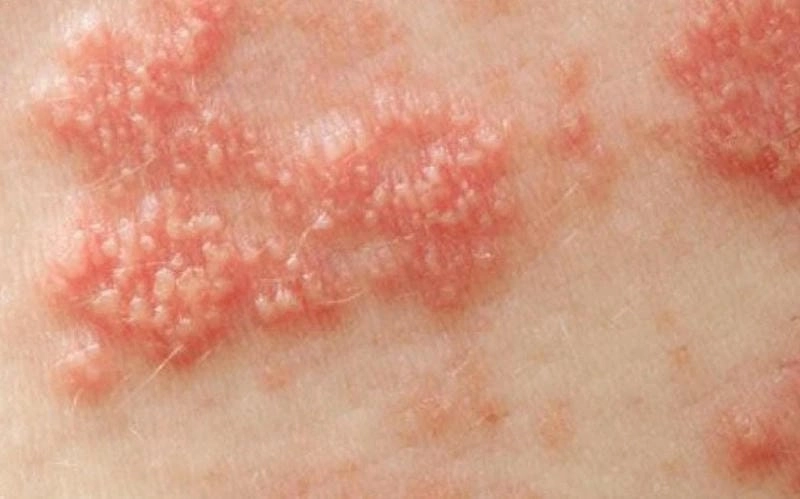 Quan sát mức độ tổn thương của em bé bị zona