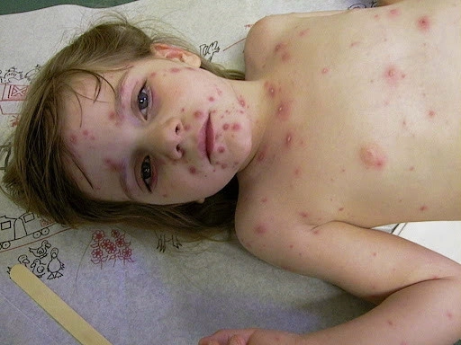 Xem hình ảnh thực tế zona o tre em cần lưu ý