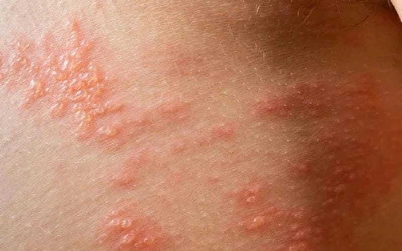 Nhận biết triệu chứng trẻ em bị giời leo qua hình