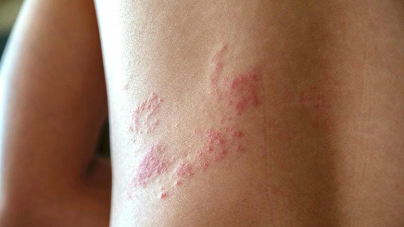 Giải đáp thắc mắc trẻ em có bị zona không bằng ảnh