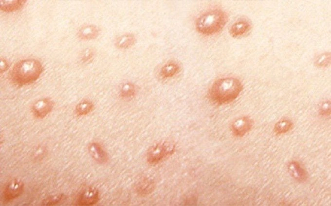 Tham khảo ảnh minh họa điều trị zona ở trẻ em tại nhà