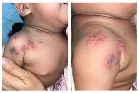 Hình ảnh minh họa chi tiết ảnh trẻ bị bệnh zona thực tế