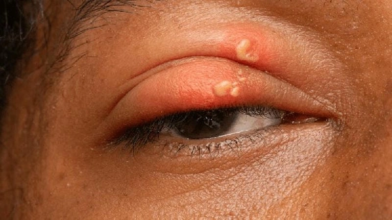 Xem hình ảnh bị zona ở mắt từ hình ảnh bệnh zona thần kinh ở mắt