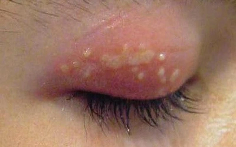 Hình ảnh bệnh zona thần kinh ở mắt giúp nhận biết dấu hiệu của bệnh zona ở mắt