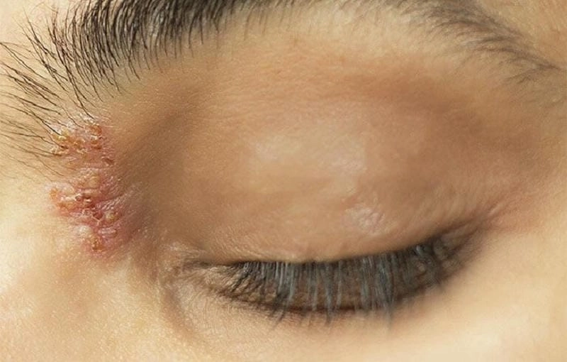 Xác định dấu hiệu zona ở mắt với hình ảnh bệnh zona thần kinh ở mắt