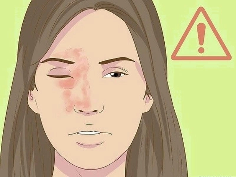 Nhận biết hiện tượng zona ở mắt qua hình ảnh bệnh zona thần kinh ở mắt