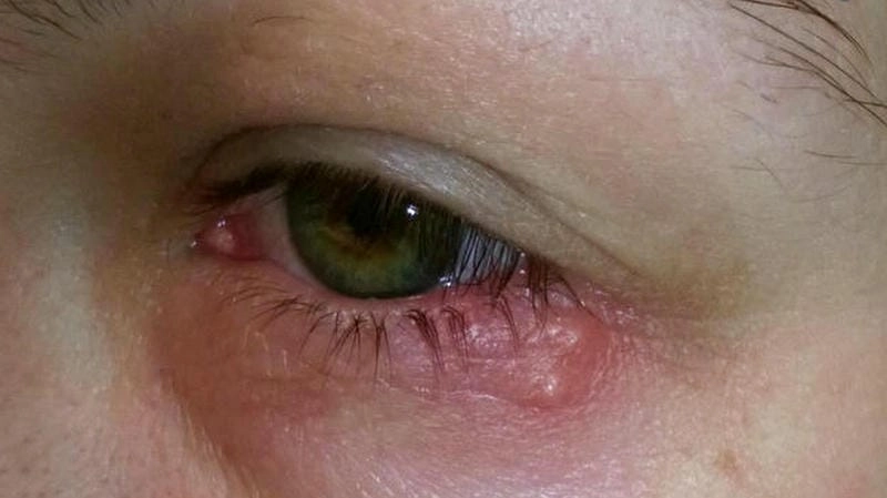 Một số mẹo chữa zona ở mắt kèm hình ảnh bệnh zona thần kinh ở mắt