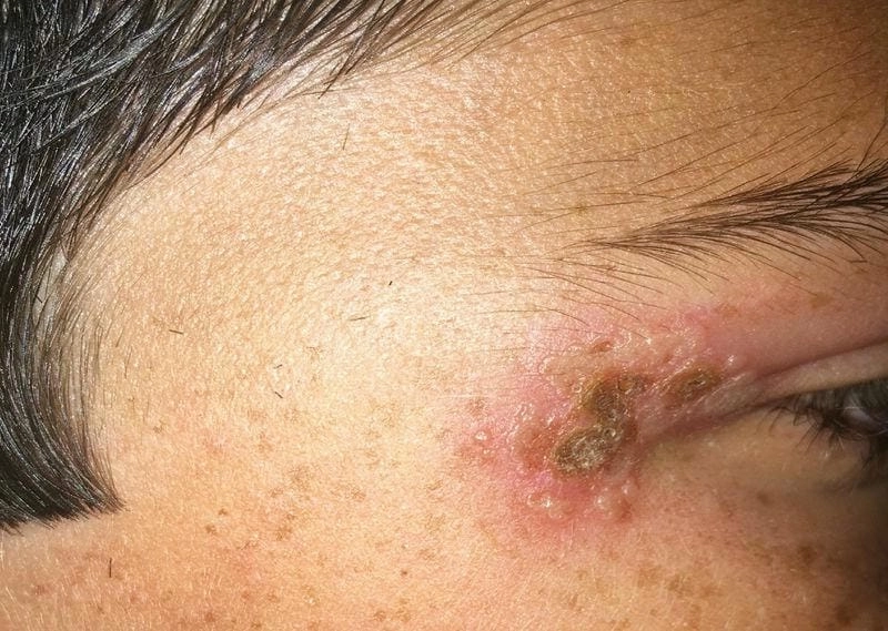 Gợi ý thuốc trị zona ở mắt dựa trên hình ảnh bệnh zona thần kinh ở mắt