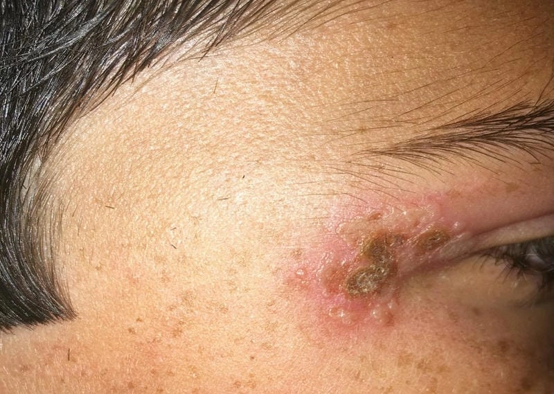 Biểu hiện zona gần mắt được thấy rõ trong hình ảnh bệnh zona thần kinh ở mắt