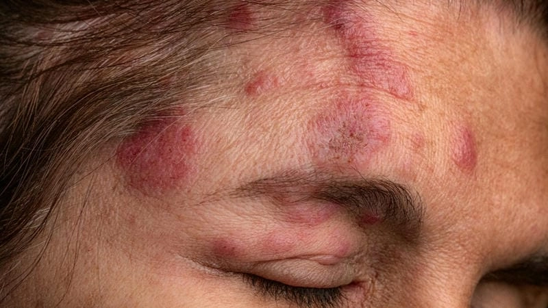 Dấu hiệu zona mí mắt qua góc nhìn hình ảnh bệnh zona thần kinh ở mắt