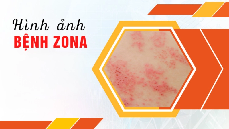 Hình ảnh bệnh zona là như thế nào gây sốc mắt người