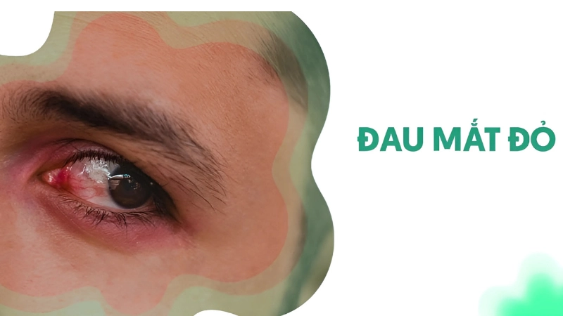 Hình ảnh bệnh đau mắt đỏ là như thế nào