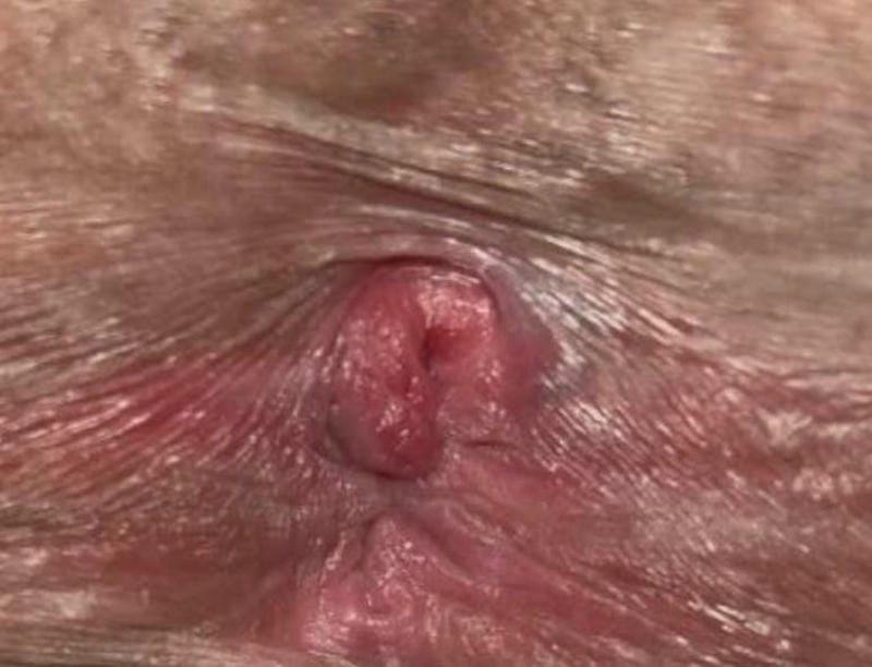 Hình ảnh bệnh trĩ ở người trẻ ngày càng phổ biến hiện nay