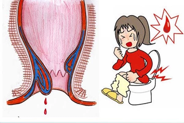 Hình ảnh biến chứng bệnh trĩ giúp cảnh báo sớm nguy cơ