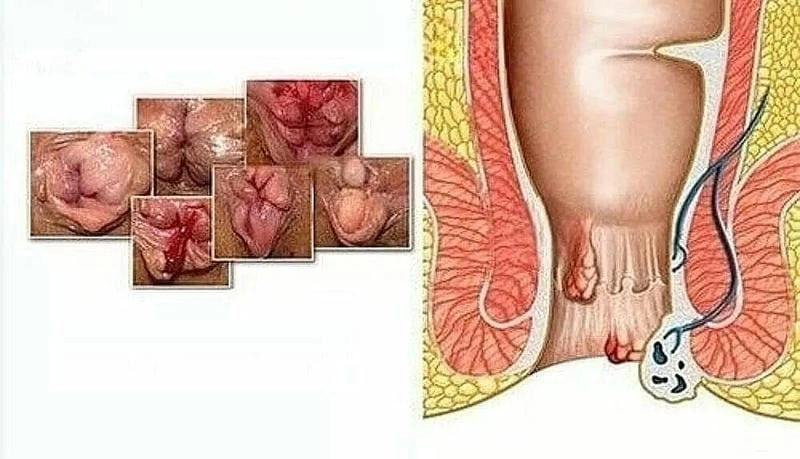 Hình ảnh bệnh trĩ khi mang thai cần chú ý chăm sóc sớm