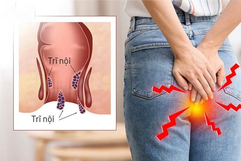 Hình ảnh bệnh trĩ có mủ cảnh báo nguy cơ nhiễm trùng