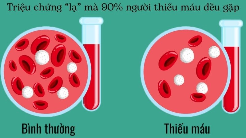 Triệu chứng “lạ” mà 90% người thiếu máu đều gặp