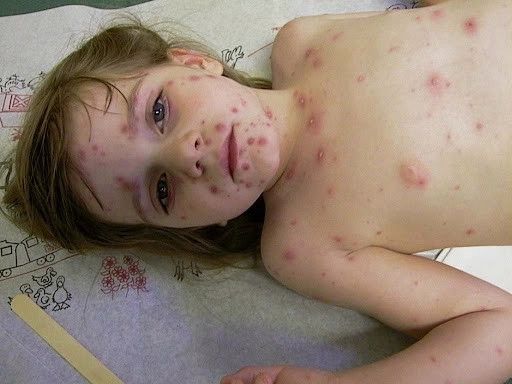 Em bé bị zona cần được đưa đi khám kịp thời